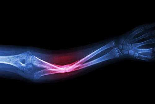 ¿Es una fractura una lesión corporal grave?