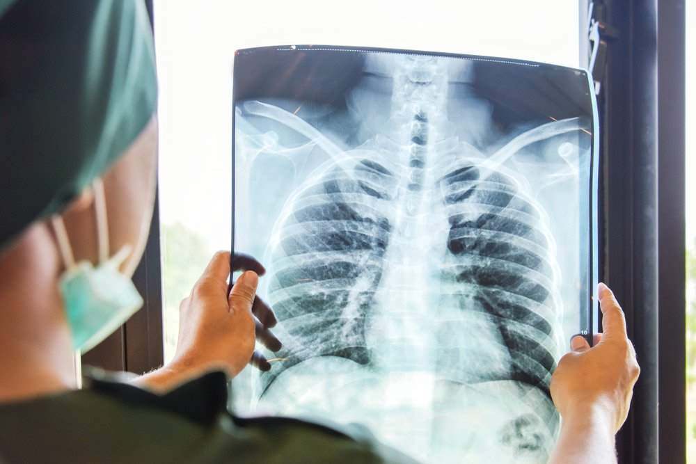 ¿Puede el Roundup causar cáncer de pulmón?