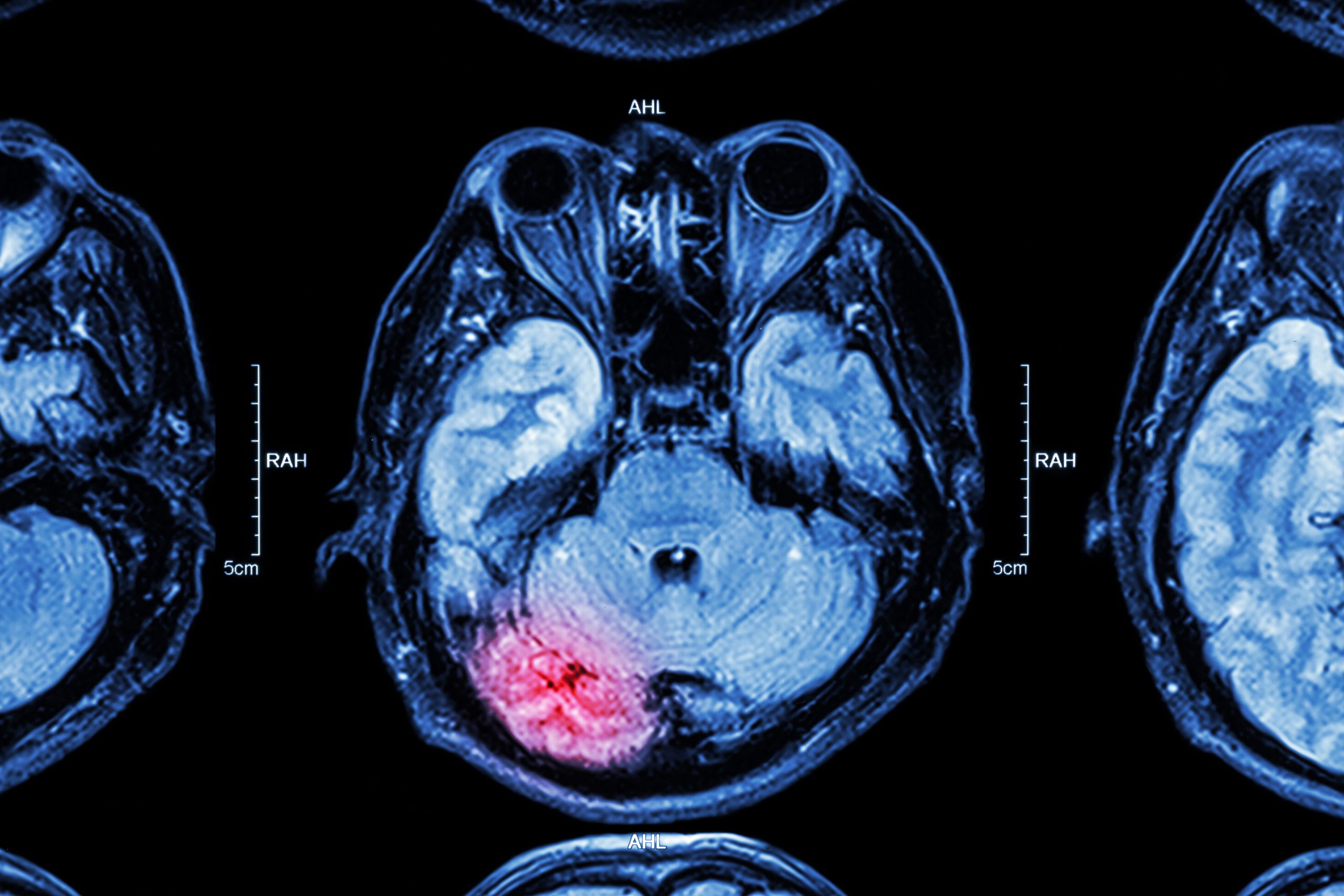 ¿Qué Hacer Cuando la Negligencia Resulta en una Lesión Cerebral?