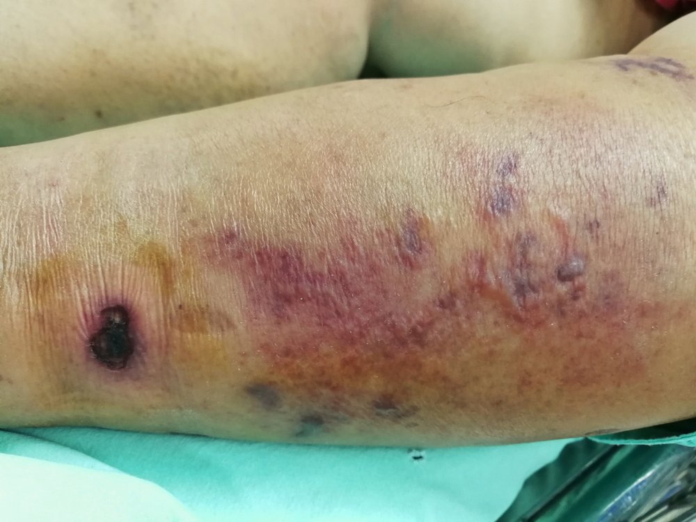 ¿Puedo Demandar por Fascitis Necrotizante en Florida si Mi Doctor Fue el Culpable?
