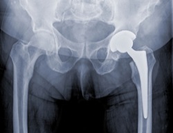 hip replacement
