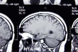 Lesión Cerebral