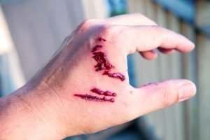 bite on hand - personal injury lawyer