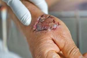 dog bite on hand