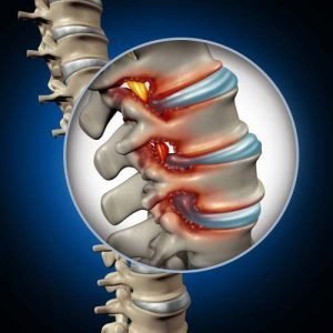 Can You Recover from a Spinal Cord Injury?