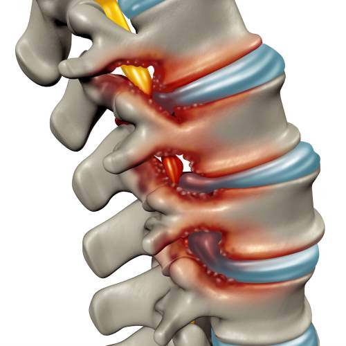 What Is Spinal Injury?