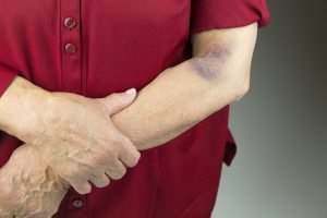 Unexplained Bruises or Cuts or Burns