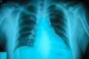 Broken Ribs Accidents