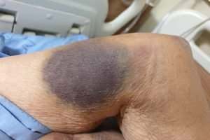 Gainesville Internal Bleeding Lawyer