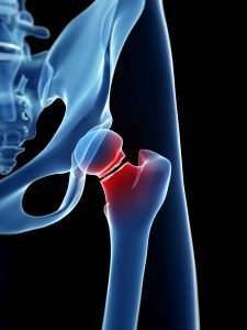 Miami Broken Hips or Pelvis Injury Lawyer