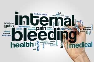 Miami Internal Bleeding Injury Lawyer