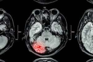 Punta Gorda, FL - Paralysis or Traumatic Brain Injuries