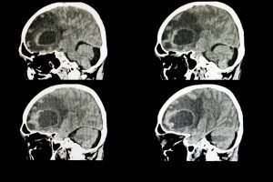 CT scan of a brain