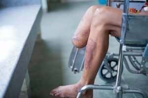 below knee amputated patient
