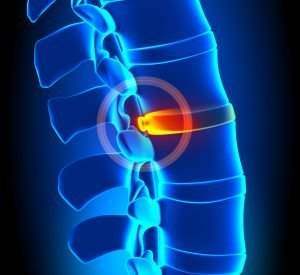 illustration of a bulging disc in a spine
