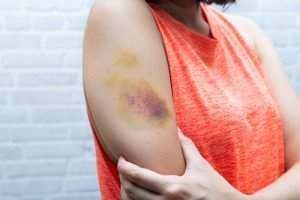 woman with a bruised arm