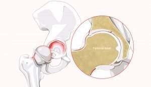 illustration of a torn labrum