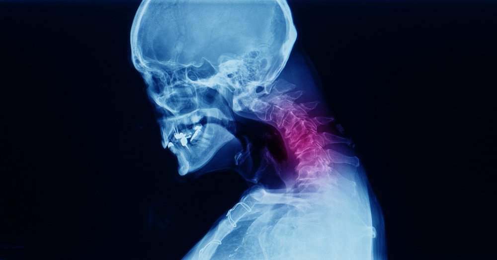 What is the Average Settlement for Cervical Radiculopathy?