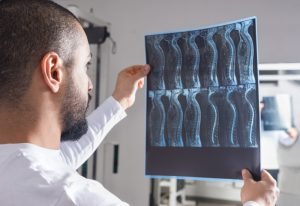 Gainesville Spinal Cord Injury Lawyer