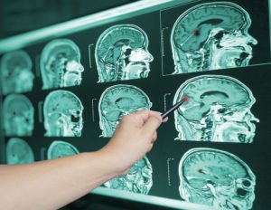 Davie Brain Injury Lawyer