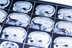 Kendall Brain Injury Lawyer