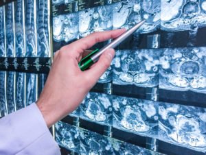 Boca Raton Medical Malpractice Lawyers