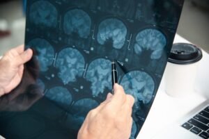Can I Sue for Anoxic Brain Injury in Florida if My Doctor Was at Fault?