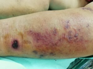 Can I Sue for Necrotizing Fasciitis in Florida if My Doctor was at Fault?