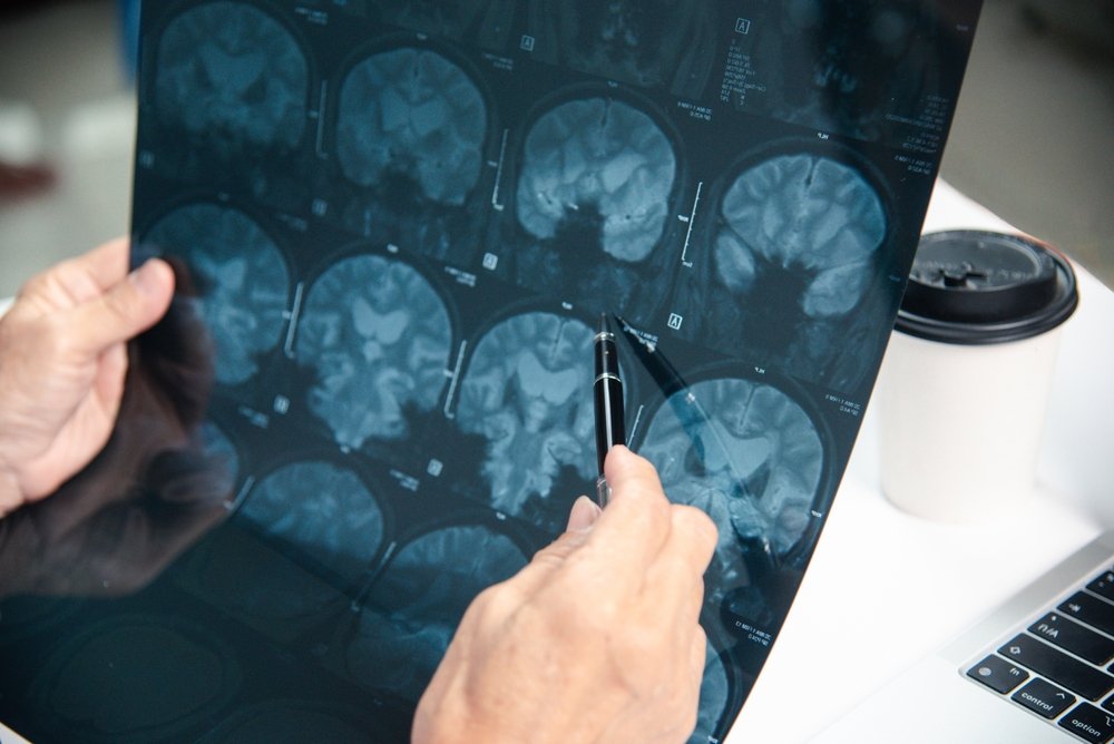 Is Compensation Available for Anoxic Brain Injury in a Florida Malpractice Case?