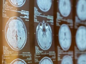 What If a Neurological Injury Was Caused by a Medical Mistake?