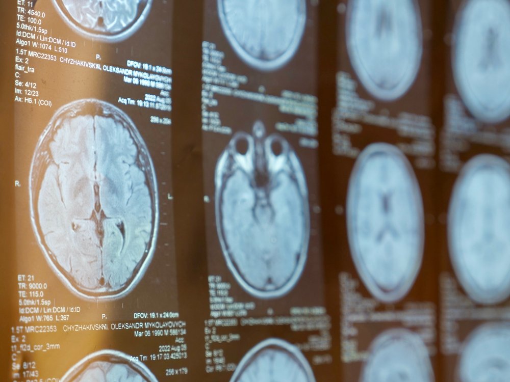 What If a Neurological Injury Was Caused by a Medical Mistake?