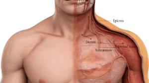 Miami Truck Accident Burn Injury Lawyer