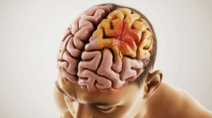 Florida Brain Damage Malpractice Injury Lawyer