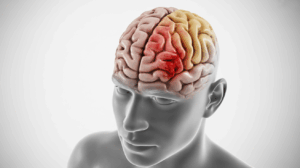 Miami Truck Accident Brain Injury Lawyer